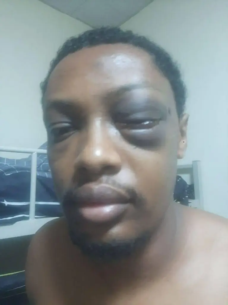 An engineer from Ethiopia is seen after a severe beating.