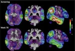 An experimental Alzheimer’s drug shows promise targeting a different brain protein, new study shows