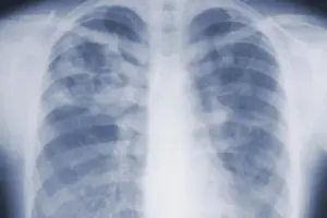 Study suggests the threat of mold-associated illnesses may be underappreciated