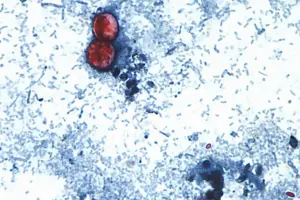 Michigan reports first 2 US deaths in outbreak of cyclospora
