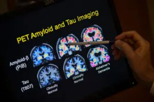 Want to lower your risk of dementia? It doesn’t involve a blood test